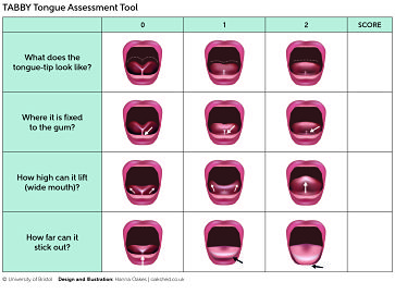 The TABBY tongue assessment tool, a chart for clinicians to use to assess ankyloglossia or 'tongue-tie' in infants.
